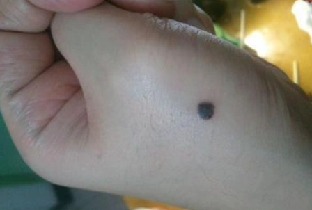 1,恶性雀斑样痣黑色素瘤表皮萎缩,基底层有较多不典型黑素细胞,并