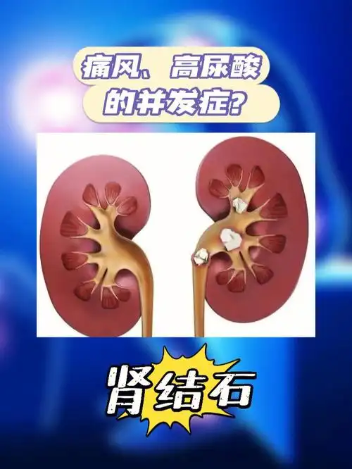 四大痛风高尿酸的并发症必须重视起来