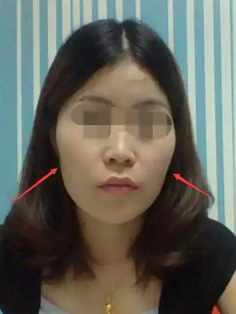 脸颊两侧凹进去正常嘛?