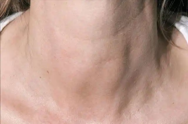 甲状腺患者发病前或会有3个症状提醒一黄二绿要少吃