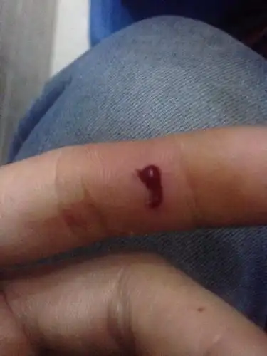 被老鼠咬了一口. 伤口 蛮深的.流了好多血. 当时就用碘酒消毒清洗过