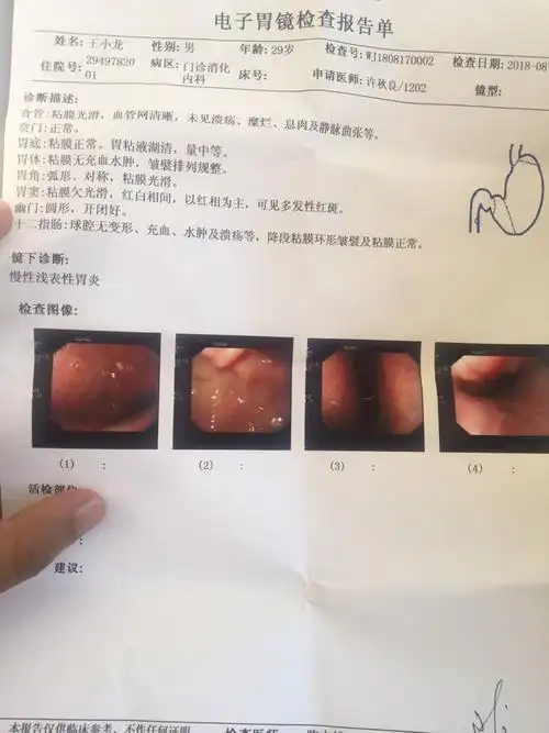 胃镜检查慢性浅表性胃炎 可图片怎么看起来表面突肿