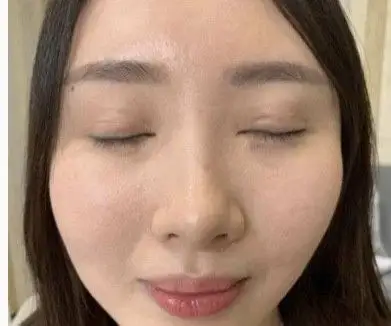 割双眼皮太深了凹陷图