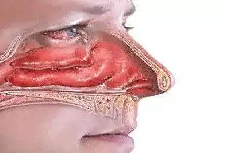 首大陈潜鼻粘膜肿胀的治疗和预防