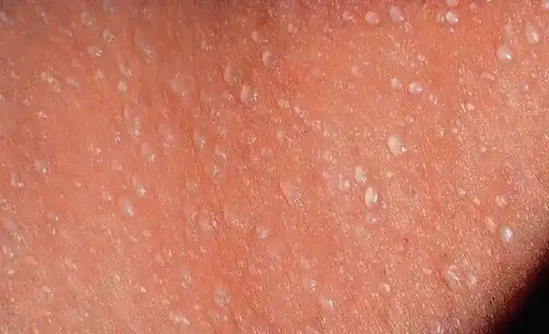 白痱子的颜色自然是白色了,甚至还有些透明,看起来就像微微发亮的小