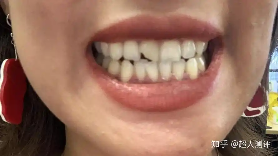 试过了水牙线我才知道自己的牙缝里塞了多少宝贝