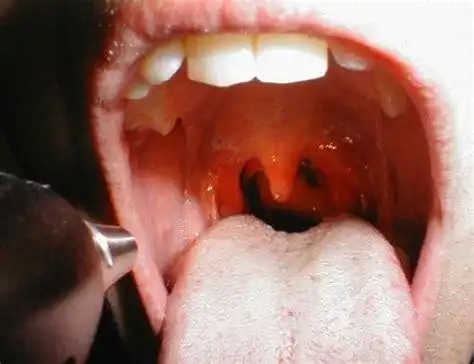 嗓子里有异物感是怎么回事