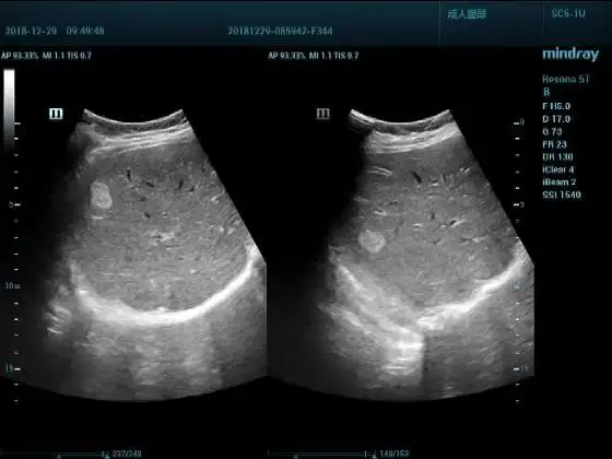 超声入门贴951肝血管瘤多例