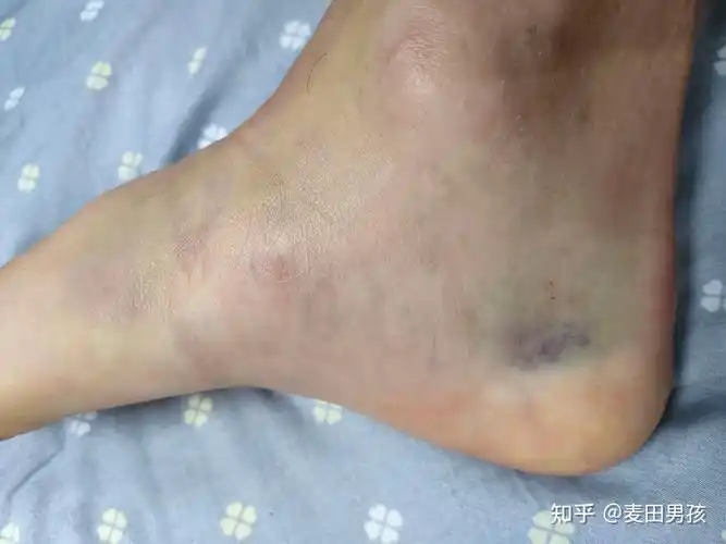 右踝关节扭伤(崴脚)恢复记录 - 知乎