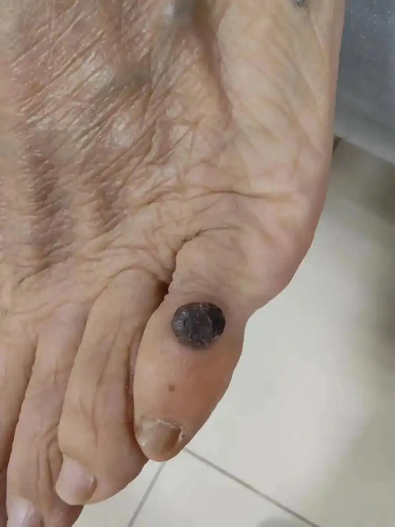 脂溢性角化皮肤镜图片 - 抖音