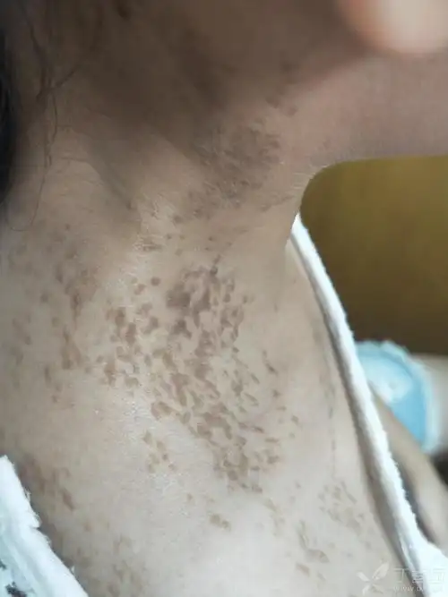 疣状表皮痣怎样治疗最好?求教