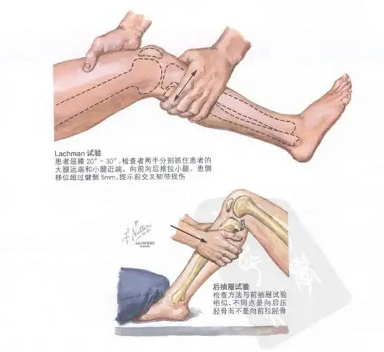 根据患者年龄特点,且否认外伤史,浮髌试验阴性,研磨试验阴性,基本排除