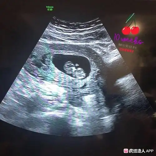 十周的宝宝 彩超时候很调皮