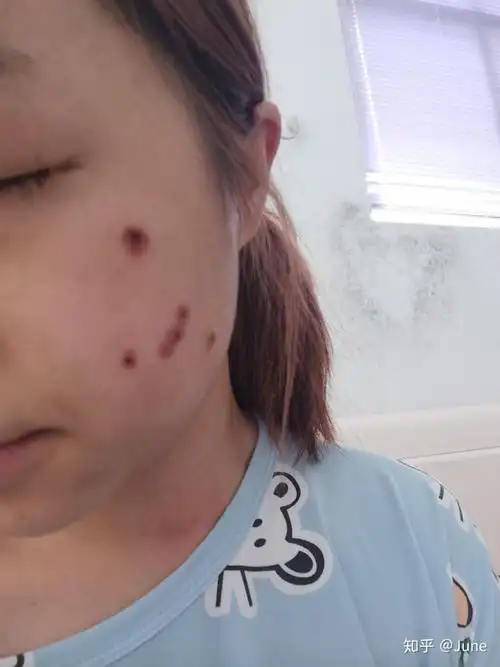 液氮冷冻点痣记录第二十天了