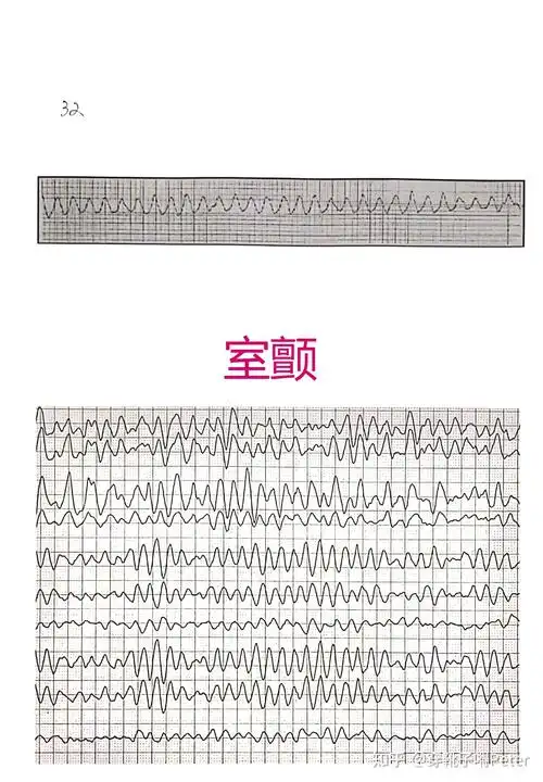 60种常见心电图一览(第三篇-室性心率失常) - 知乎