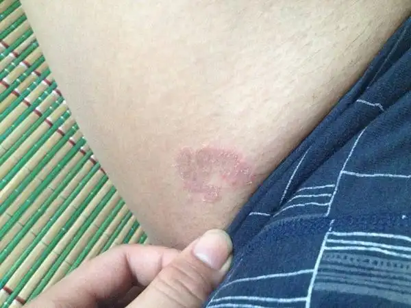 叫梅毒硬下疳软下疳和硬下疳区别硬下疳会长在阴囊上吗硬下疳和上火痘