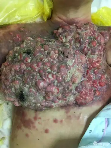 图片为我们护理过的乳腺癌大面积溃烂的患者
