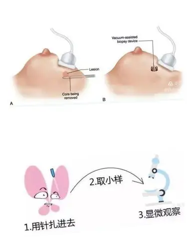 又一项技术填补我院空白——功能科成功开展超声引导下乳腺结节穿刺