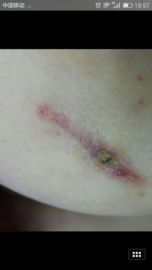 乳腺良性手术一个月了伤口还没长好中间一个黄色的痂,不疼,不红肿.