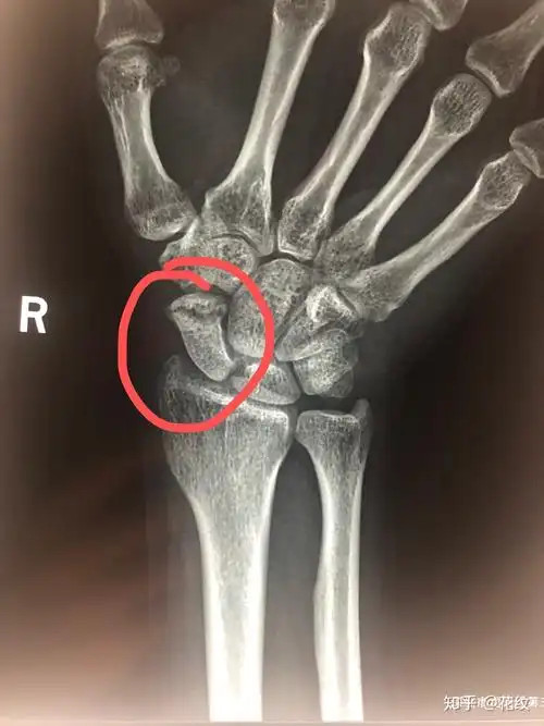 手腕舟骨骨折经历