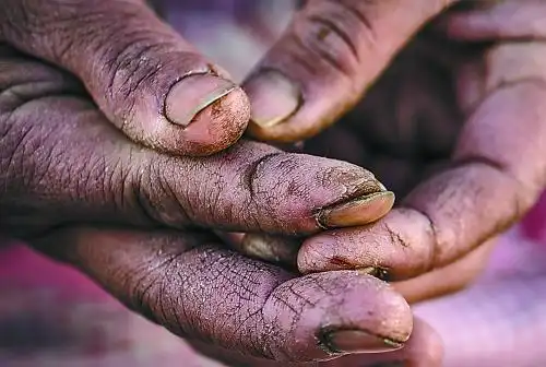 陈文芬被冻裂的手.