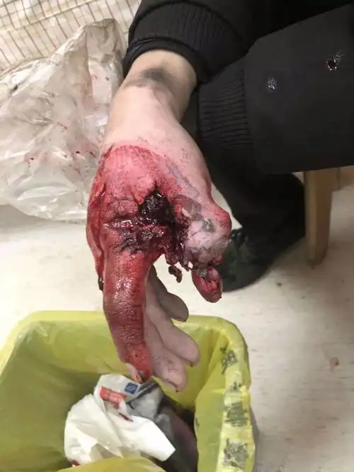 年轻帅哥手指被压断,医生竟然将断手缝进肚子,这是神马操作?