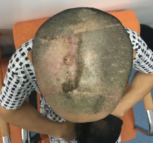 你见过这样的头皮创伤吗? - 美篇