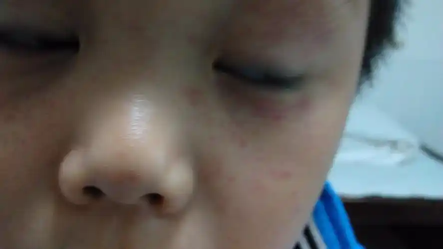 7岁小孩做人体倒立后面部两眼周围出现很多红色斑点,血常规白细胞计数