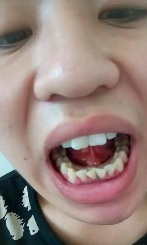 舌头下面肿了不怎么疼是上火了吗还吃点什么药