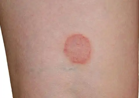 皮肤圆圈癣长什么样皮肤圆圈癣图片