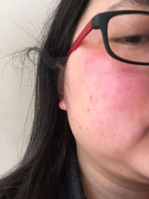 圈子 系统性红斑狼疮 >正文  其实确诊之前到上个月复查止,我的脸上