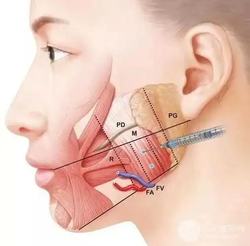 在咬肌中间1/3处2cm处进行注射.