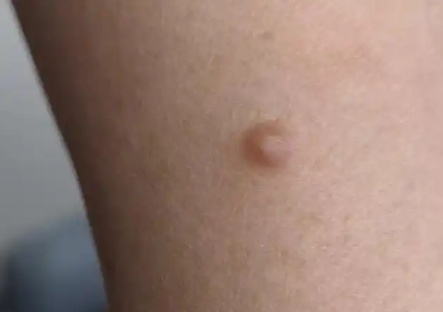 身上的小疙瘩——硬纤维瘤