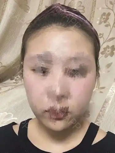 瘦脸针打完第八天了～我真没有任何咬不动东西的感觉,_圈子-新氧美容