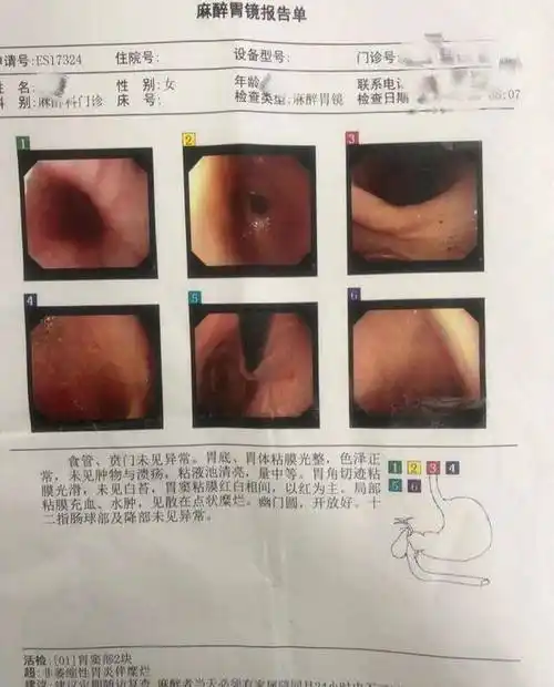 太严重,但我真的无时无刻不受胃酸胃疼胃胀气的煎熬,所以坚持做了胃镜