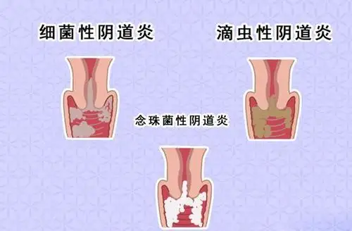 阴道炎(vaginitis)即阴道炎症,是导致外阴阴道症状如瘙痒,灼痛,刺激和