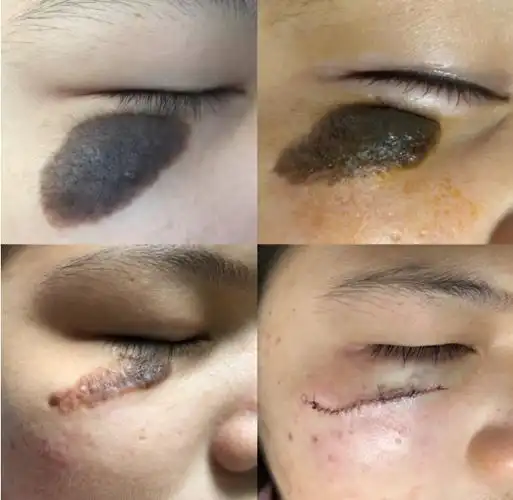 身上长痣,到底要不要治疗,是手术好还是激光治疗好?