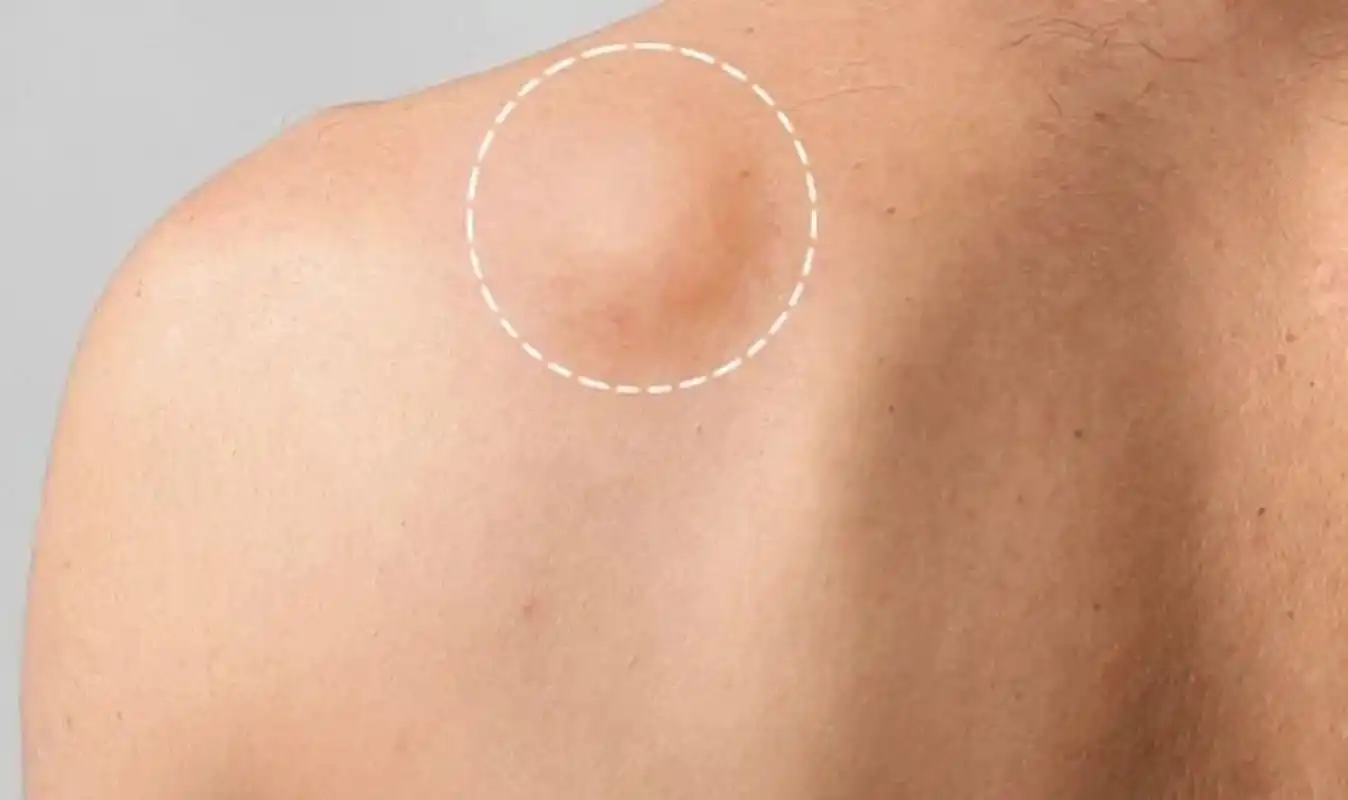 晚上睡觉的时候,老公发现她后背肿起一个"包块",诊所医生说是脂肪瘤