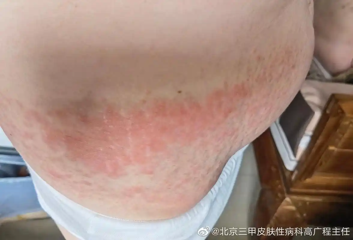 腰两侧起好多疹子,有的像水泡,特别痒,去年夏天起过一次,当时按湿疹