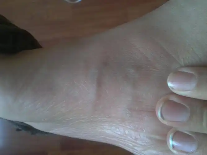 坐久了脚发冷,一走路就痛,脚上有凸起的像筋一样的