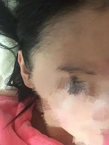 我23岁额头两侧发黑大该两年了,平时生活也很注意,不抽烟不喝酒,偶尔