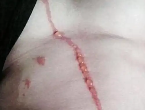 男子腹部现离奇红痕 经检查发现系蜘蛛钻进皮肤