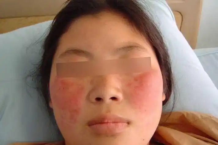 红斑狼疮早期图片_有来医生