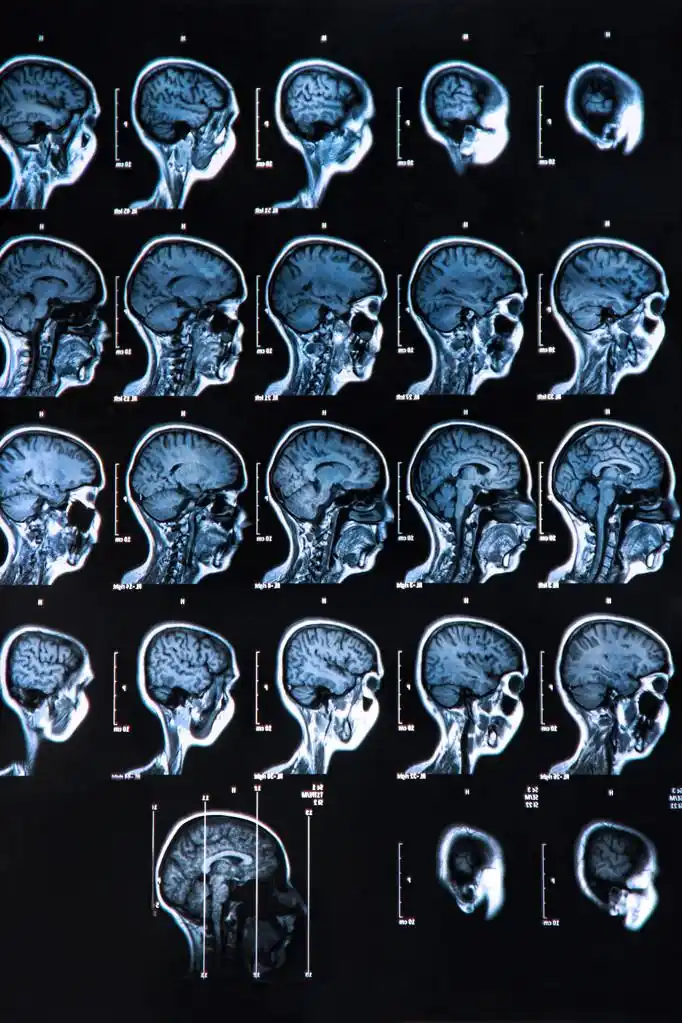 磁共振成像大脑扫描
