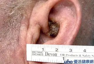 七旬翁耳廓长痘 竟是耳癌!