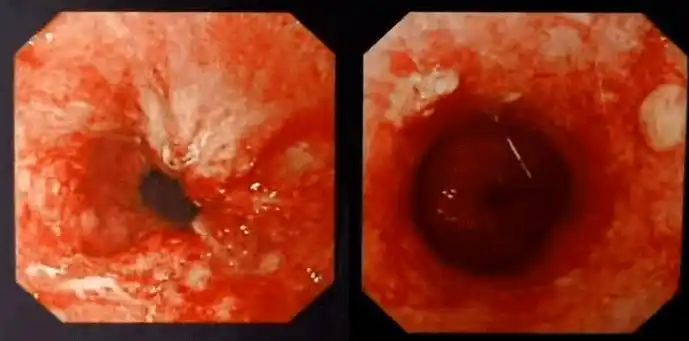 食管一线之光新辅助免疫联合化疗用于局晚期食管鳞癌患者3周期达术后