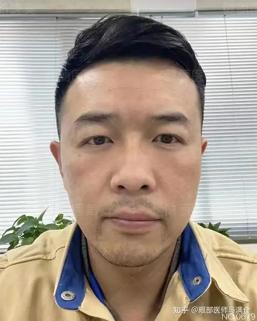 40岁男人的困扰竟是眼袋泪沟这还有救吗