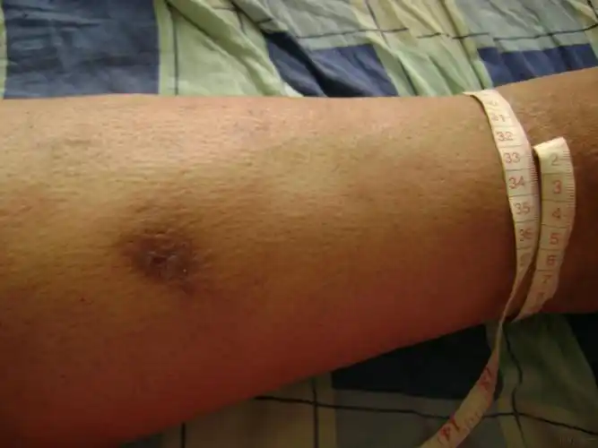 大家谁见过橡皮腿丝虫病这个像不像我没见过