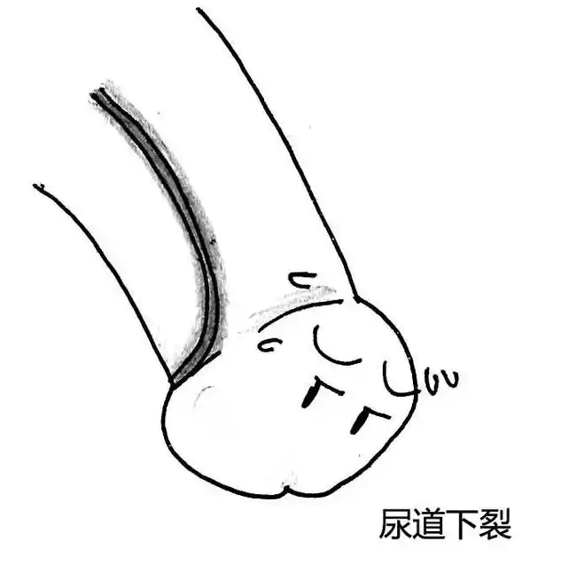 可能是尿道下裂!(上篇)