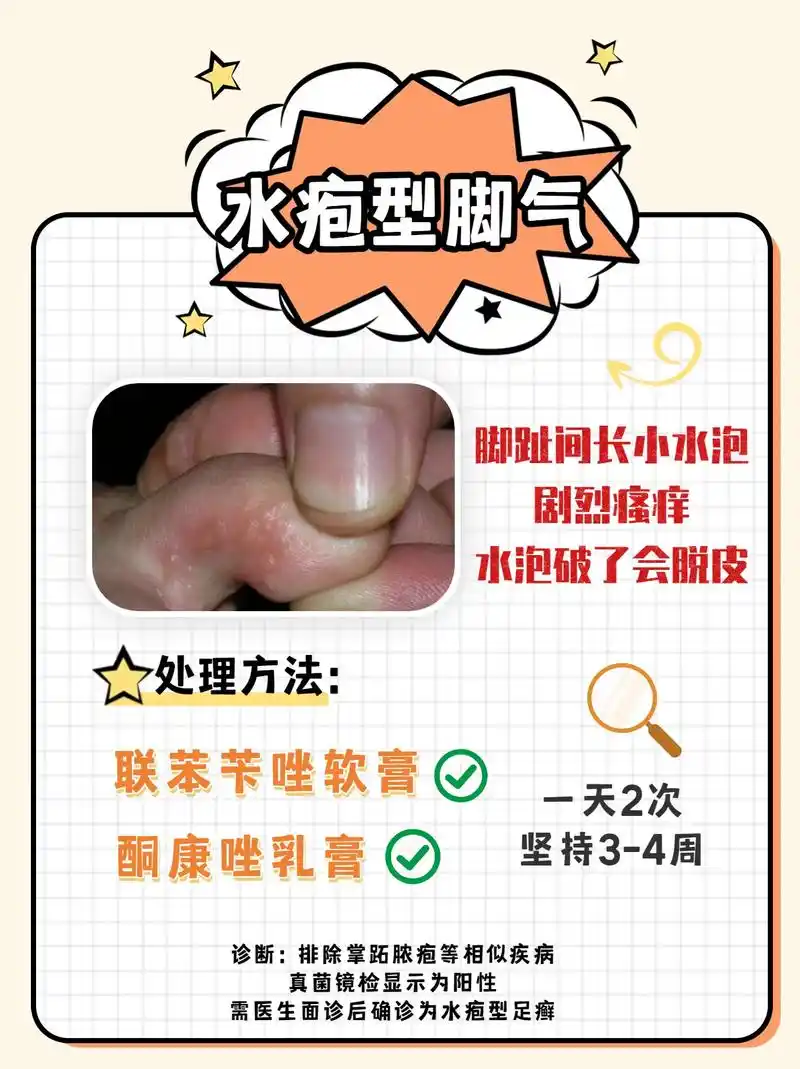 3种常见脚气用药分享,建议点赞收藏!#医学科普 #皮肤 #脚 - 抖音